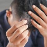 Dr. Bruce Marko Hair Loss